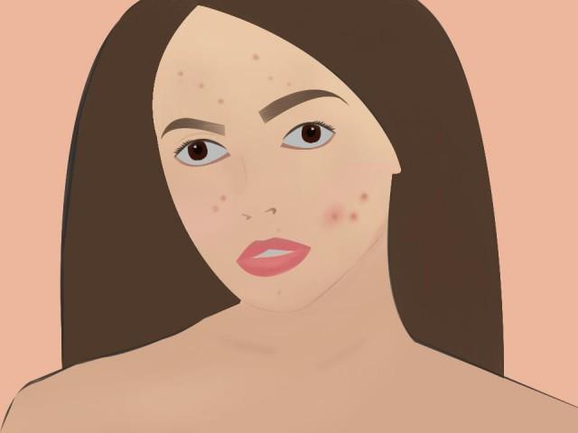acne and other skin conditions