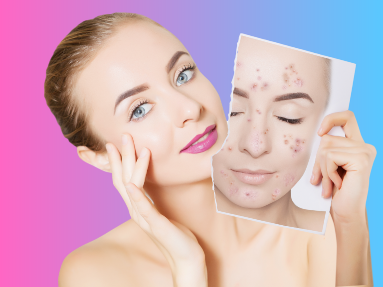 Acne Mistakes: These are the Number-One Mistakes People Make